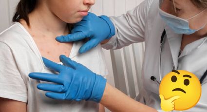 Brote de sarampión: ¿Cómo evitar contagiarte y qué hacer si me da?
