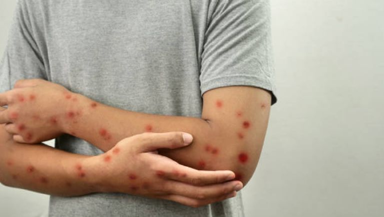 Contagios de sarampión incrementan, estos son los síntomas